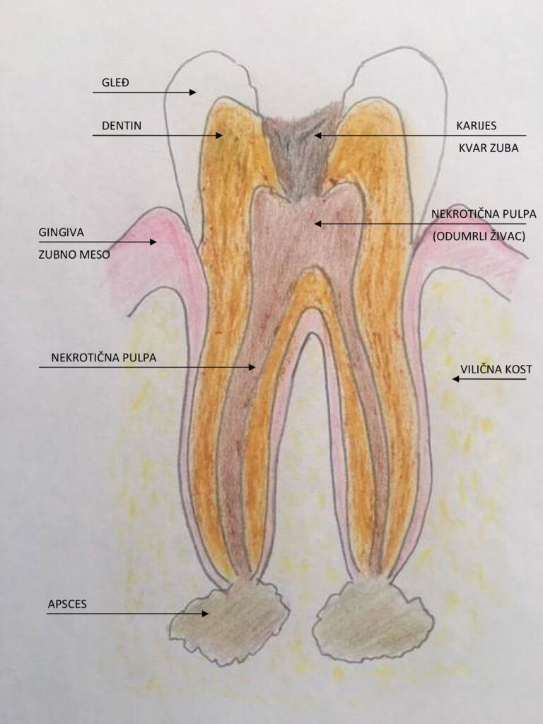 Šematski prikaz apikotomije - Dental centar Slavija