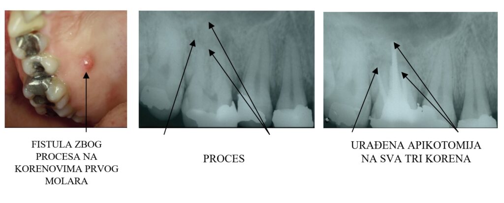 Apikotomija zuba - Dental centar Slavija