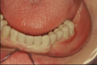 Postupak bisekcije - Dental centar Slavija