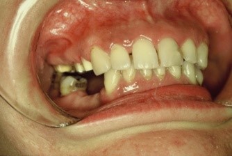 Elongacija zuba - Dental centar Slavija