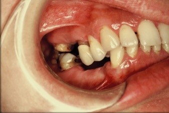 Elongacija zuba - Dental centar Slavija