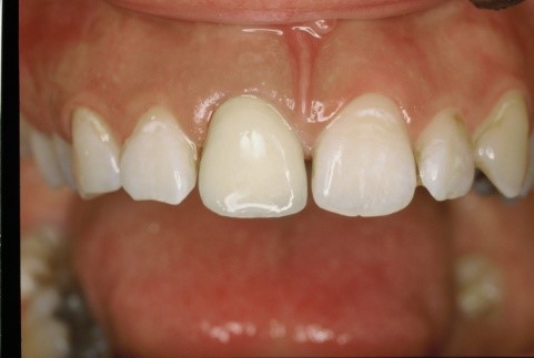 Endodoncija - Dental centar Slavija
