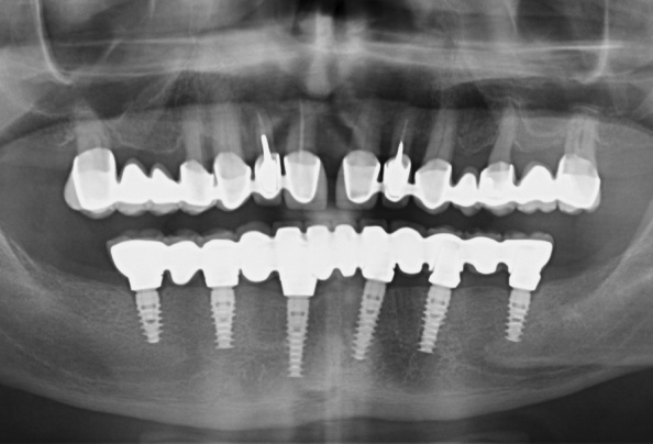 Ugrađeni implanti rendgenski snimak - Dental centar Slavija