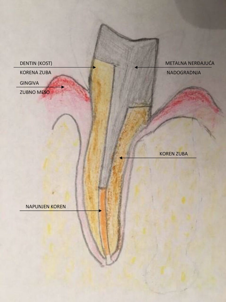 Šematski prikaz hemisekcije zuba - Dental centar Slavija