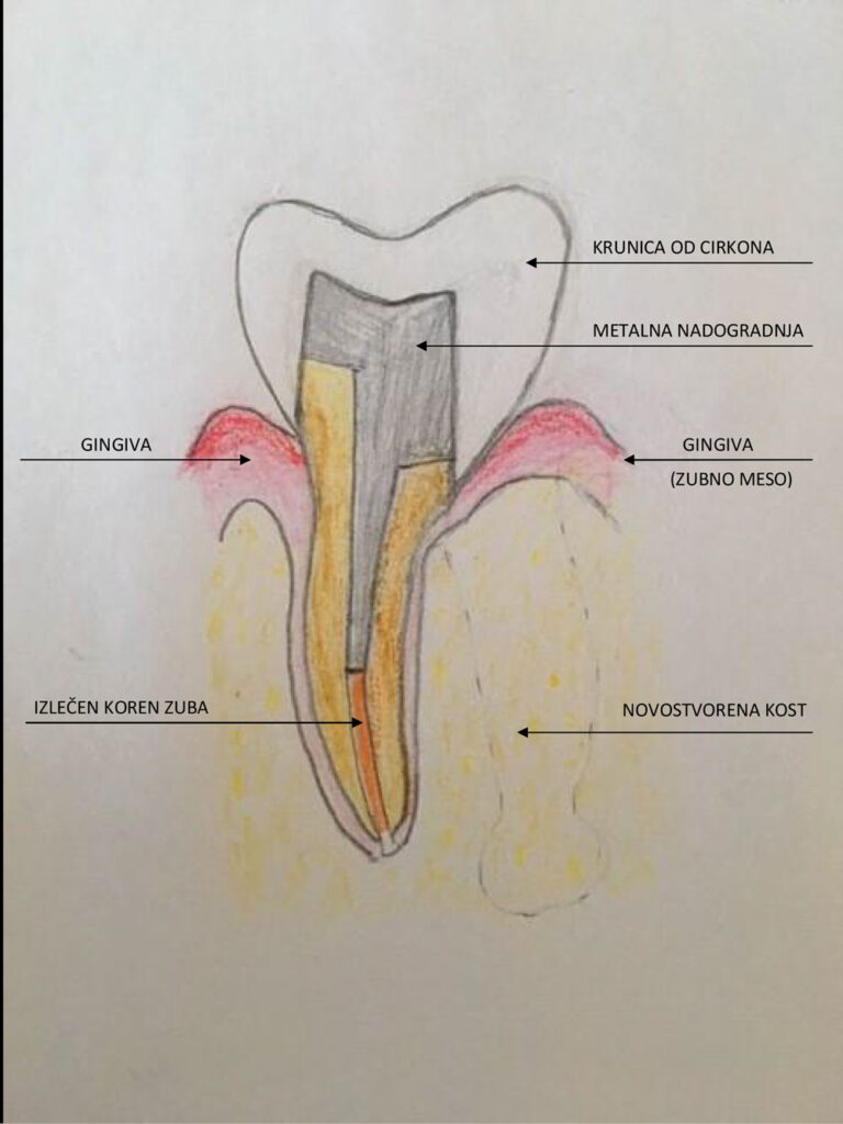 Šematski prikaz hemisekcije zuba - Dental centar Slavija