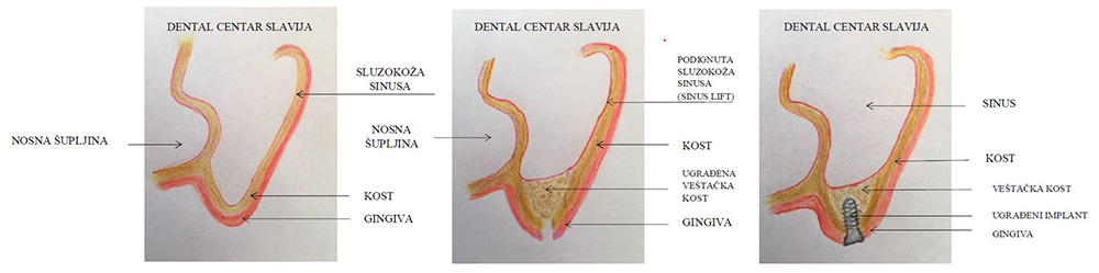 Implantologija - Sinus lift - Dental centar Slavija