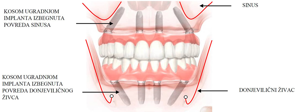 Implantologija ugradnja implanta - Dental centar Slavija