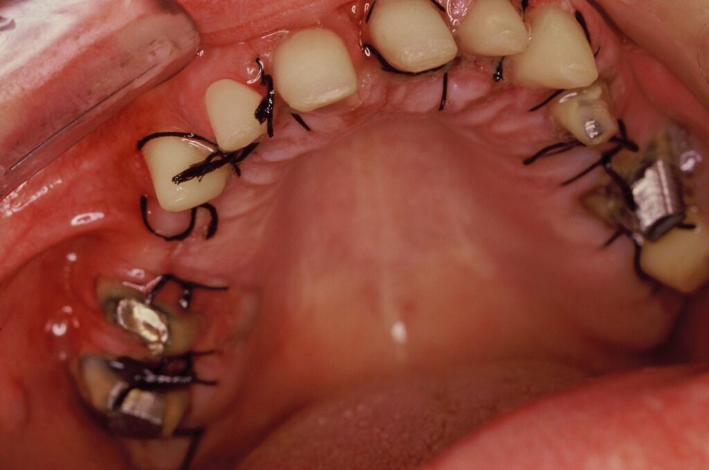 Parodontologija - Modifikovana Widman (režanj) operacija - Dental centar Slavija