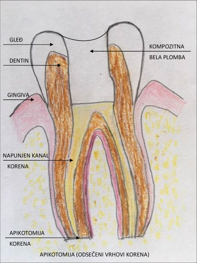 Šematski prikaz apikotomije - Dental centar Slavija