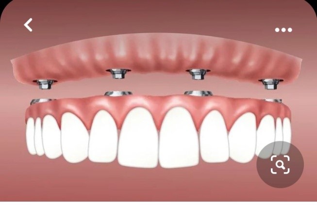 Proteza na četri implanta-Zubne-proteze - Dental centar Slavija
