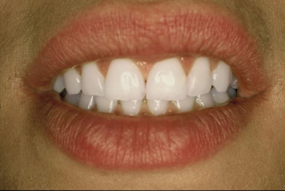 Izbeljivanje zuba - Dental centar Slavija