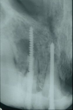 Transdentalni implanti- Snimak ugradnje implanata - Dental centar Slavija