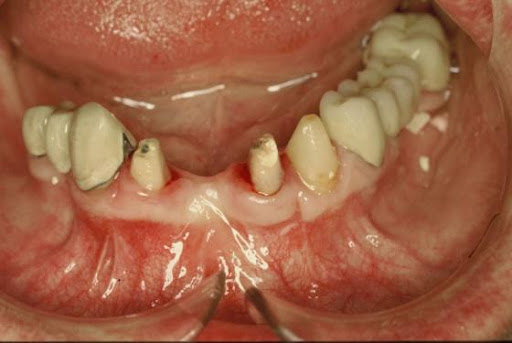 Transdentalni implanti - Dental centar Slavija